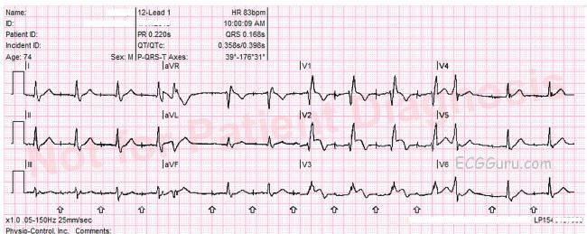 acute m i with right bundle branch block and atrial pacing rbbb ecg