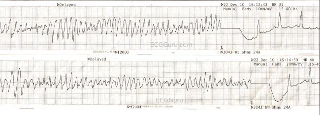 Ventricular Fibrillation Wikipedia