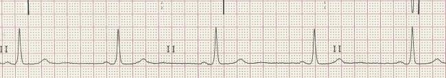 Rhythm Strip Ecg Guru Instructor Resources Rhythm Strip Ecg Guru Instructor Resources