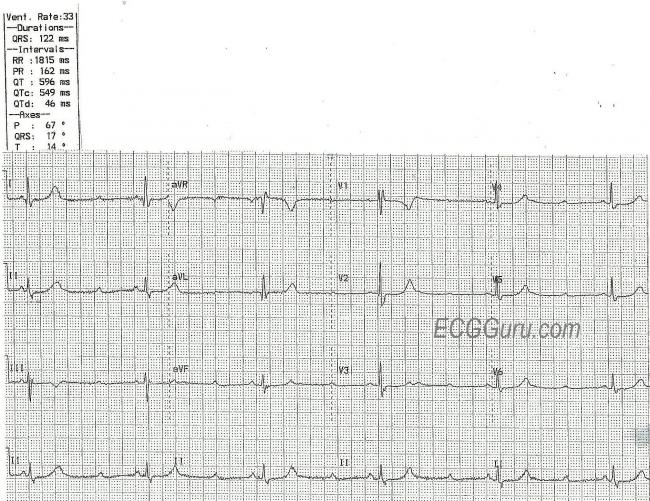 High Grade Av Block Ecg Guru Instructor Resources