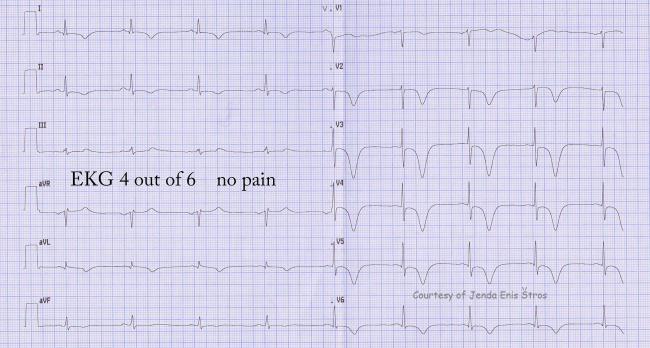ecg t wave inversion v1