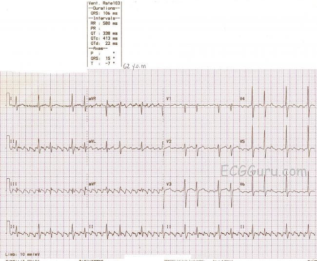 a flutter regular or irregular a flutter regular or irregular