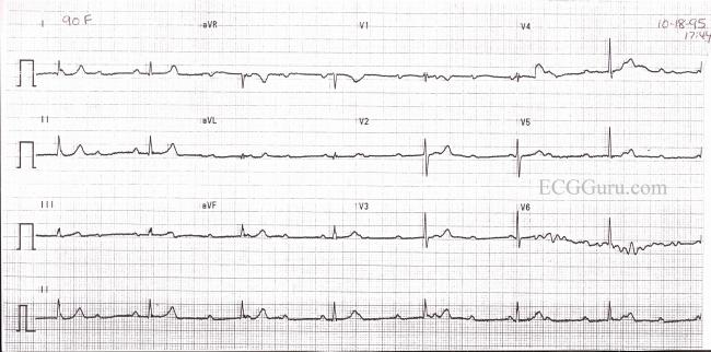 Complete AV Block With Junctional Escape Rhythm | ECG Guru - Instructor ...