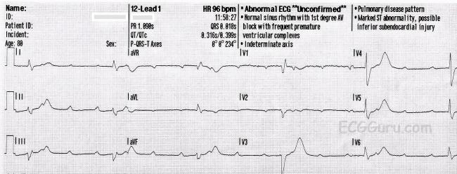 Av Block Ecg Guru Instructor Resources