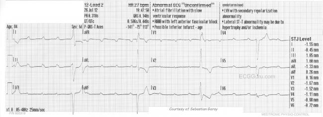 Complete Heart Block Ecg Guru Instructor Resources