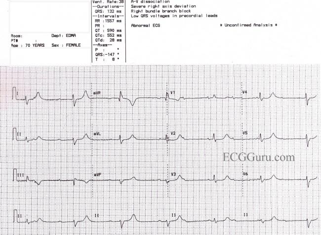 Prolonged QTc Interval ECG Guru Instructor Resources prolonged-qtc-interval-ecg-guru-instructor-resources