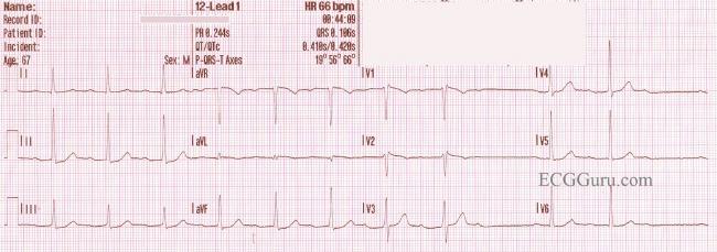 Second Degree Av Block Type I Ecg Guru Instructor Resources