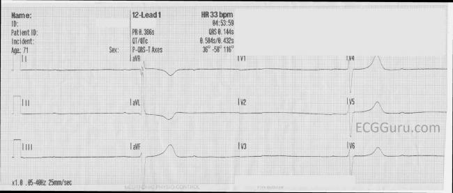 First Degree Av Block Ecg Guru Instructor Resources