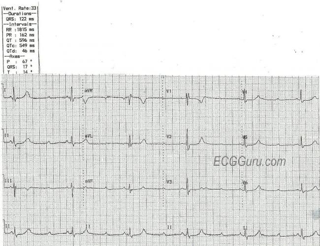 Second Degree Av Block Type Ii Ecg Guru Instructor Resources Second Degree Av Block Type Ii Ecg Guru Instructor Resources
