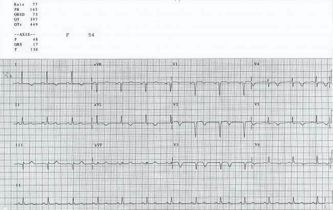 pathological q wave pathological q wave