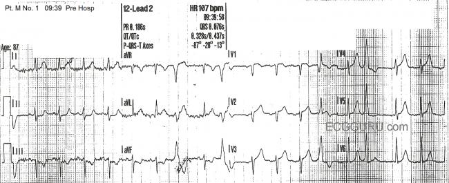 Anterior wall MI with subtle ST changes, STEMI 