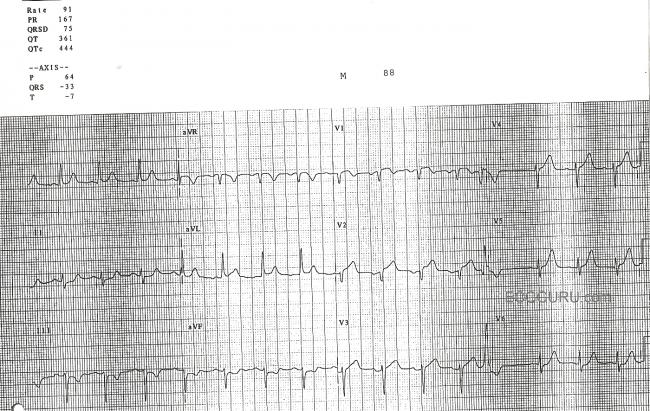 Anterior Wall MI with Subtle ST Changes, STEMI