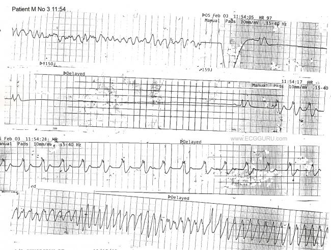 Cardiac Arrest, Rhythm Strip, V Tach, Torsades de pointes, Idioventricular Rhythm