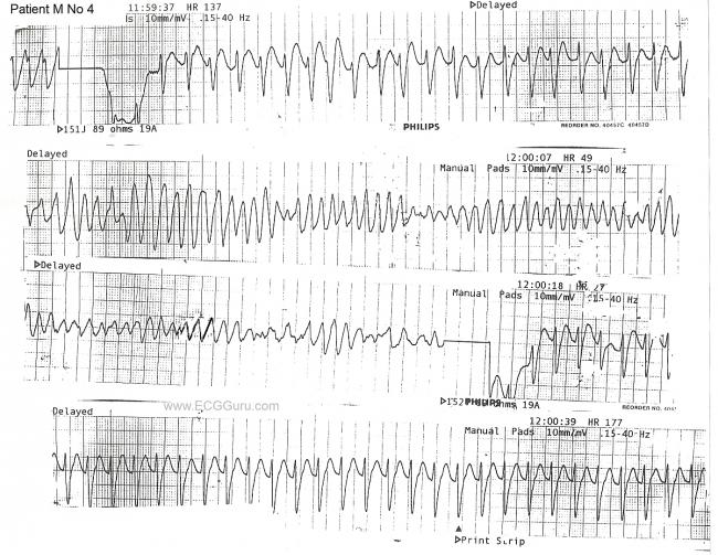 Rhythm strip, Cardiac Arrest, V Tach, V Fib, Wide Complex Tachycardia, Torsades de Pointes