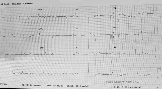 Ventricular Bigeminy Ecg Guru Instructor Resources