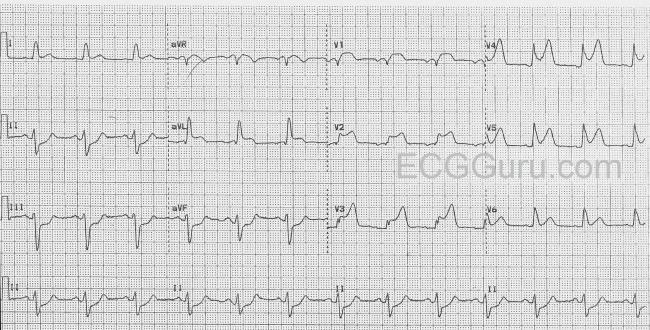 St Elevation Ecg Guru Instructor Resources St Elevation Ecg Guru Instructor Resources