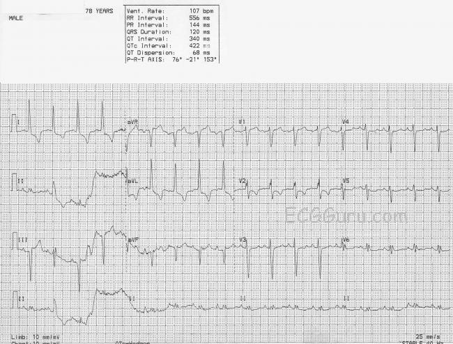 left atrial abnormality and a tremulous baseline left atrial abnormality and a tremulous baseline