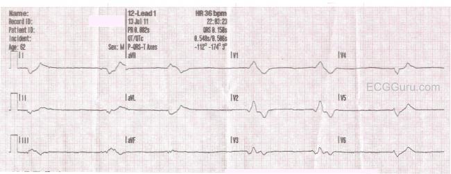 Digitalis Toxicity | ECG Guru - Instructor Resources