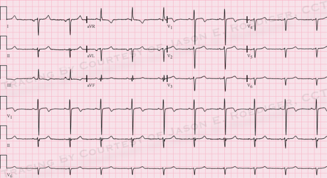 Dextrocardia Ecg Guru Instructor Resources Dextrocardia Ecg Guru Instructor Resources