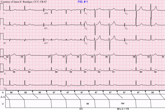 floating p r interval ecg guru instructor resources wct rate chart