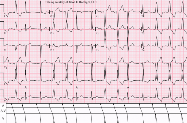 atrial fibrillation and atrial flutter icd 10
