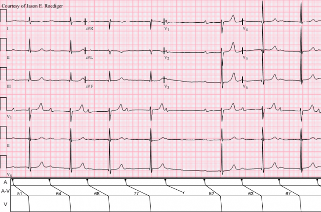 Second Degree Av Block Ecg Guru Instructor Resources Second Degree Av Block Ecg Guru Instructor Resources