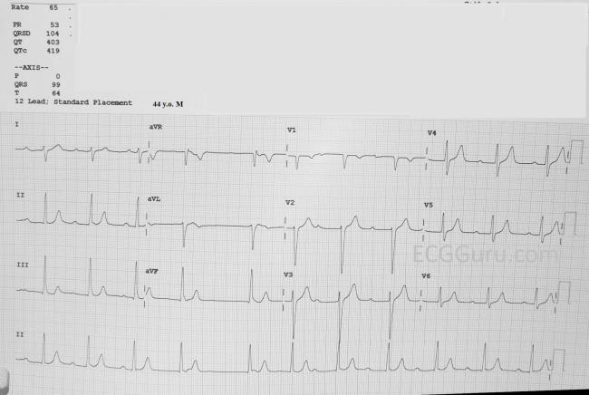 Sinus Arrhythmia Ecg Guru Instructor Resources