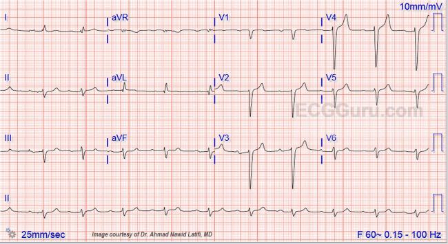 sinus rhythm ivcd sinus rhythm ivcd