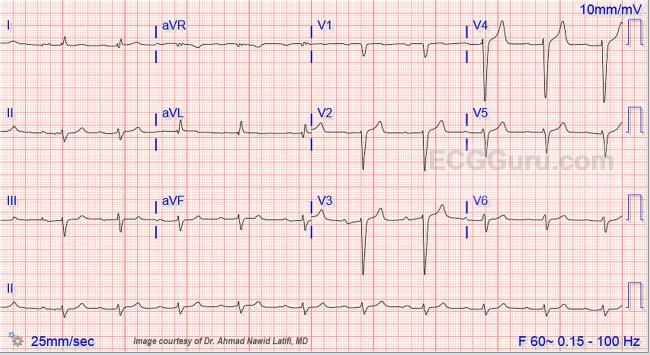 Wide Qrs Complex With First Degree Av Block Ecg Guru Instructor Resources