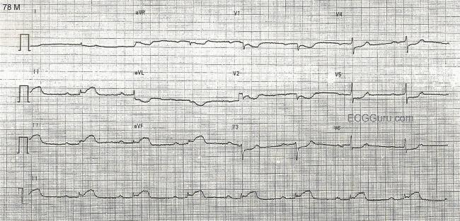 Inferior Wall M I With Sinus Bradycardia And First Degree Av Block Ecg Guru Instructor Resources