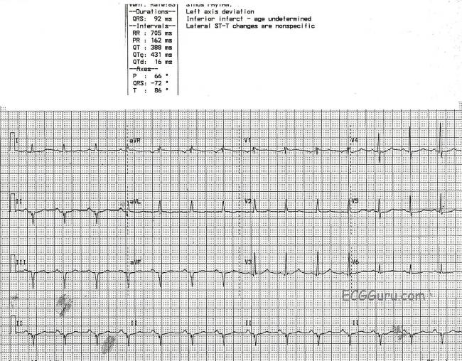 Left axis deviation ecg guru instructor resources
