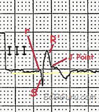 rbbb ecg