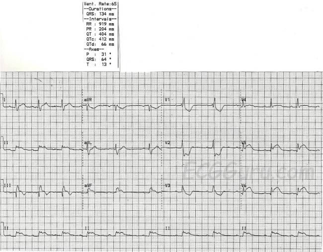 inferior wall m i and right bundle branch block ecg guru rbbb ecg