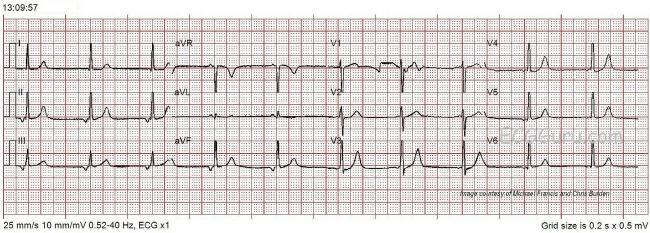 atropine on junctional escape rhythm atropine on junctional escape rhythm