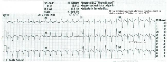 Sinus Tachycardia Ecg Guru Instructor Resources