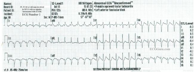 Sinus Tach Vs Svt In An Inebriated Patient Ecg Guru Instructor Resources Sinus Tach Vs Svt In An Inebriated Patient Ecg Guru Instructor Resources