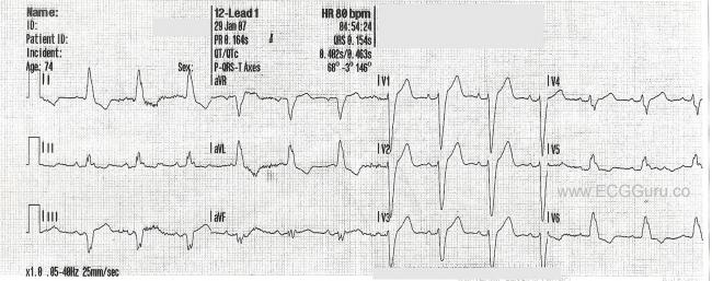 Left Bundle Branch Block Ecg Guru Instructor Resources Left Bundle Branch Block Ecg Guru Instructor Resources