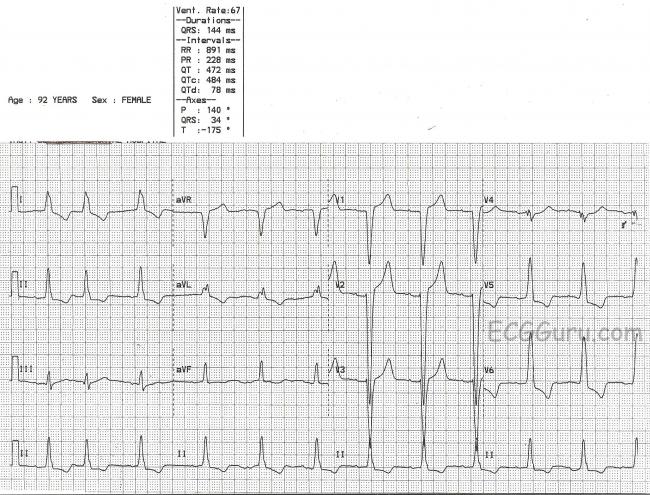 Left Bundle Branch Block Ecg Guru Instructor Resources Left Bundle Branch Block Ecg Guru Instructor Resources
