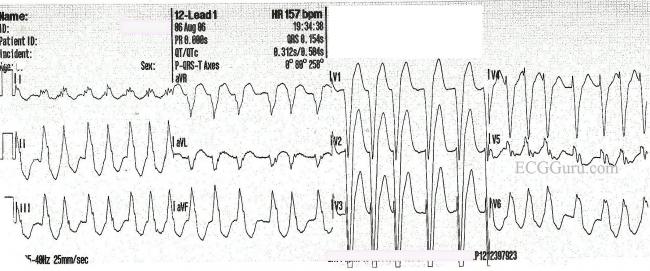 Teaching Series Atrial Fibrillation With Left Bundle Branch Block Ecg Guru Instructor Resources