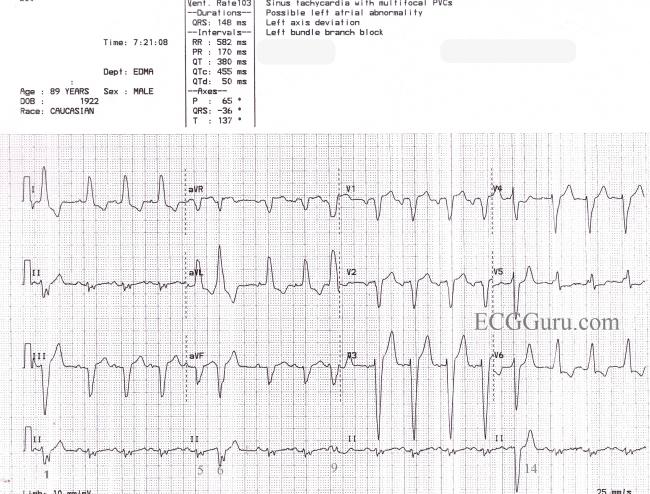 Sinus Rhythm With Left Bundle Branch Block Pvcs And Fusion Beats Ecg Guru Instructor Resources