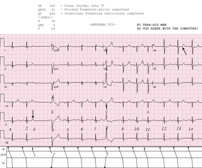 Sinus Rhythm With Ectopy Ecg Guru Instructor Resources Sinus Rhythm With Ectopy Ecg Guru Instructor Resources