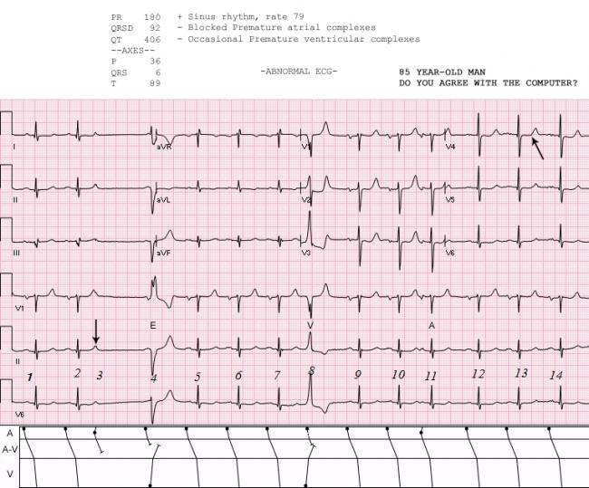 Pvcs Ecg Guru Instructor Resources