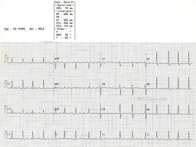 Atrial flutter with variable conduction | ECG Guru - Instructor Resources