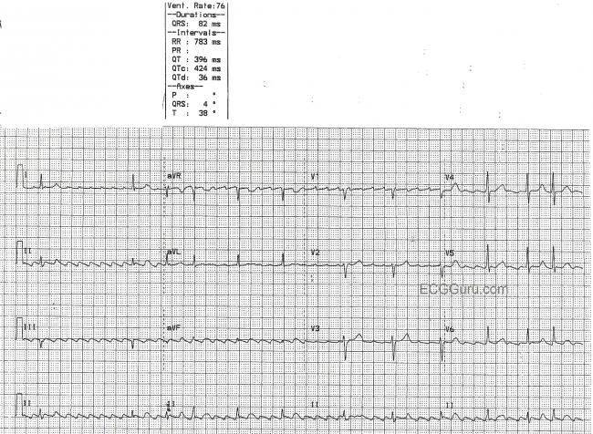 Atrial Flutter With Variable Conduction Ecg Guru Instructor Resources Atrial Flutter With Variable Conduction Ecg Guru Instructor Resources