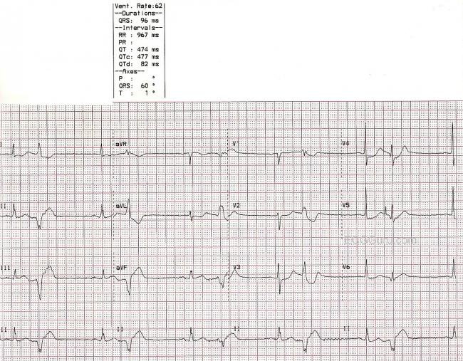 Ventricular Bigeminy Ecg Guru Instructor Resources Ventricular Bigeminy Ecg Guru Instructor Resources