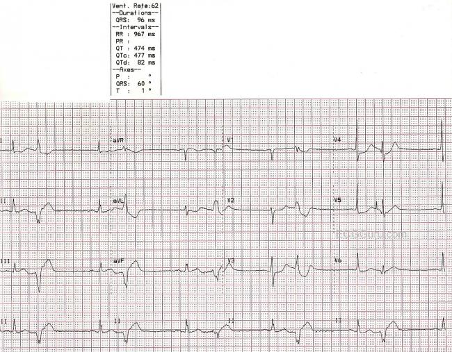 Ventricular Bigeminy Ecg Guru Instructor Resources