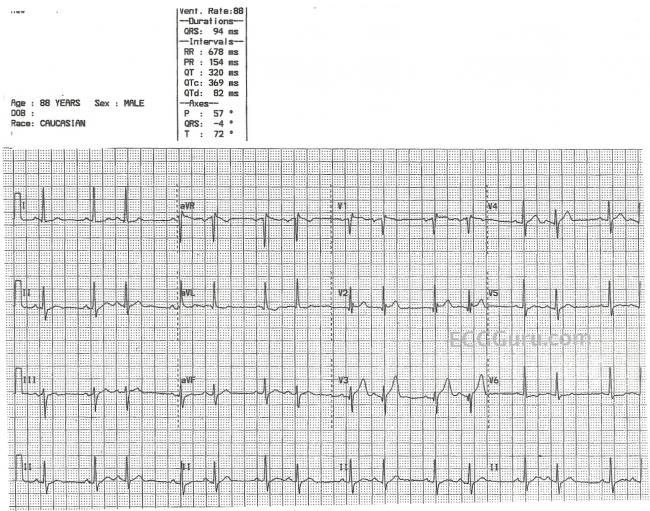 Sinus Rhythm With Atrial Bigeminy Ecg Guru Instructor Resources