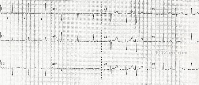 Normal Sinus Rhythm With Pacs Misdiagnosed As Atrial Fibrillation Ecg Guru Instructor Resources Normal Sinus Rhythm With Pacs Misdiagnosed As Atrial Fibrillation Ecg Guru Instructor Resources