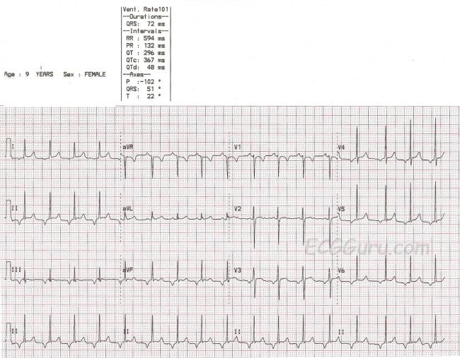 inverted p waves ecg guru instructor resources p wave ecg