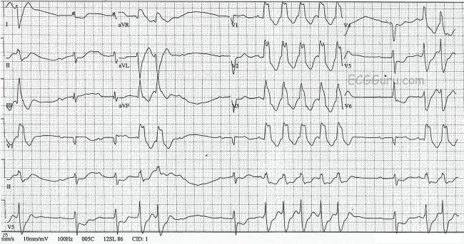 Long Pr Interval Ecg Guru Instructor Resources